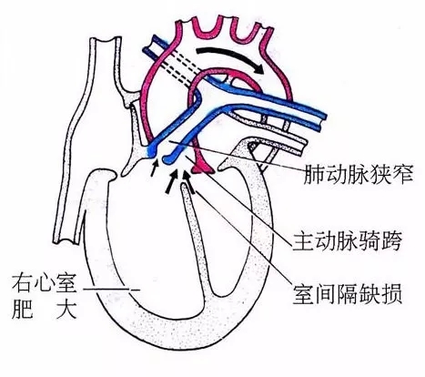 法洛四联症是怎么回事