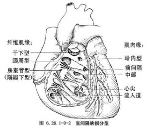 室间隔缺损的并发症有哪些