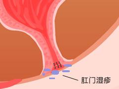 如果出现了肛门湿疹的症状就一定要及时去正规的肛肠专科医院检查