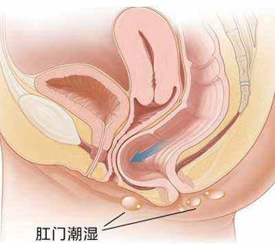 肛周湿疹是怎么回事