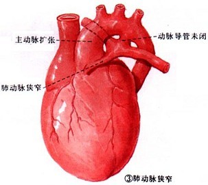 法洛四联症检查