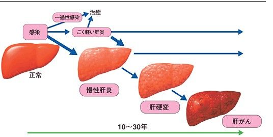 肝硬化病人口渴咋回事_肝硬化病人图片(2)