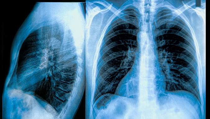 肺癌 (8).jpg