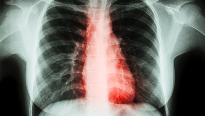 肺癌晚期胃胀什么原因