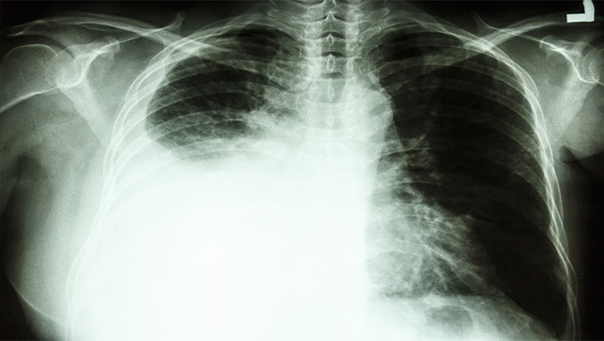 肺癌 (7).jpg