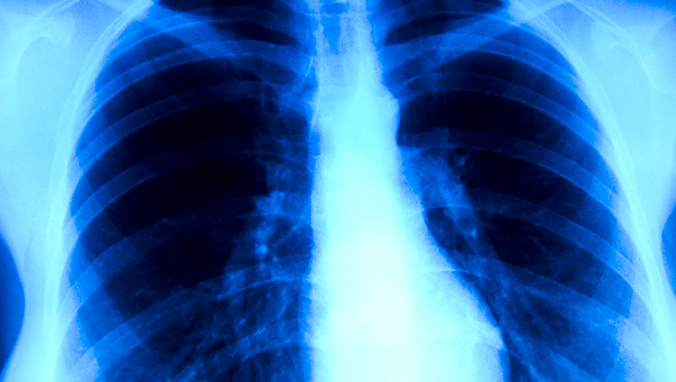 肺癌 (1).jpg