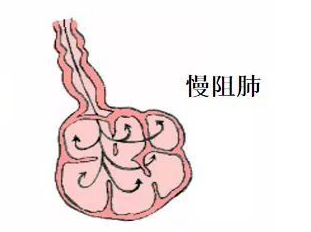 肺气肿如同一把藏在人体里的慢小刀，2019年我们中国人死因