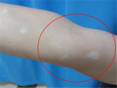 夏季白癜风该如何预防病症再次复发呢？