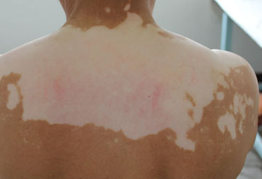 色素脱失和白癜风的早期区别 oYYBAFZ3Y6CAC9Q9AAFeagw5Oiw197.png