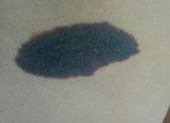 色素痣恶变症状 oYYBAFZ8sIWAYaY9AAFDYC8TIcM44.jpeg