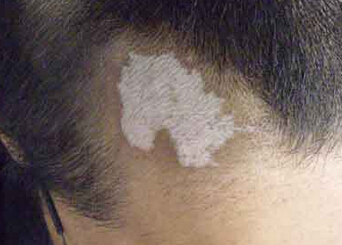 啥是白癜风 oYYBAFaJ4SSAaOZXAAFQCy7WJik14.jpeg