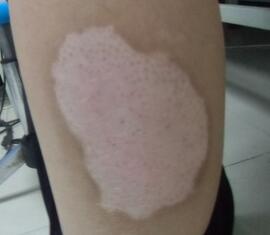 色素脱失和白癜风有什么区别 oYYBAFaJ69qAUgUuAAAX9M9Fh7A22.jpeg