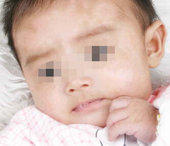 色素脱失和白癜风的早期区别 oYYBAFaKA3mAFmH4AAGvrFWXxm879.jpeg