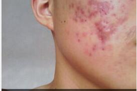 粉刺脓包型痤疮治疗 ooYBAFankK-ALOVBAAAVLF7LdSw01.jpeg