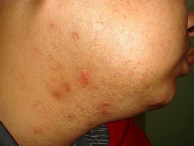 白塞氏病究竟会不会死呢