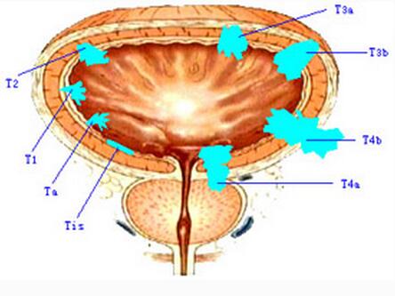 > 肿瘤科 > 肿瘤外科 > 膀胱癌 > 饮食