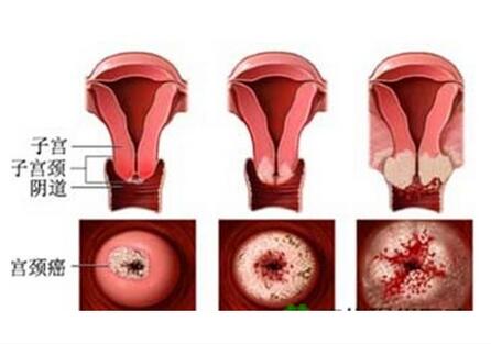 宫颈癌的外观图片图片