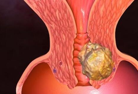 卵巢癌中期图片