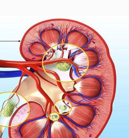 肾结石一般多大年龄得的 ooYBAFffez2ARot0AABEDLgULZg42.jpeg