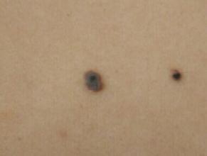 什么是黑色素瘤初期 ooYBAFf8HVWAcNRLAAAPDlEcQmo10.jpeg