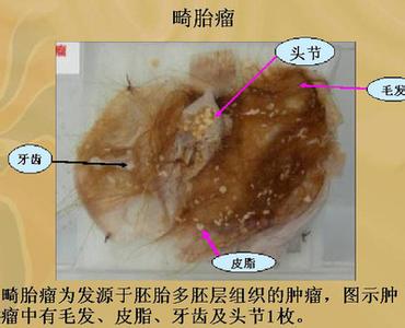 怎么购买投资型保险 > 畸胎瘤手术可以报销吗 好医保畸胎瘤2015年12月