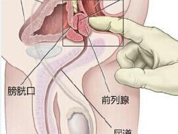 前列腺医院排名_医院取前列腺液图片