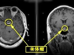 什么叫垂体瘤 ooYBAFi8FMCAG0ttAABUChIMDXk37_260x195.jpeg