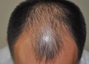 脱发严重是什么原因男性 o4YBAFjbUqaAKUcQAAAlno0KwIM05.jpeg