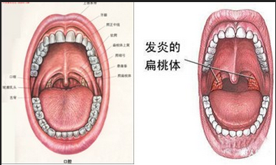 口腔扁桃体正常图片图片
