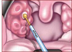 口腔结石去除 oYYBAFj256-AWanwAAAe8TOd8DQ73.jpeg