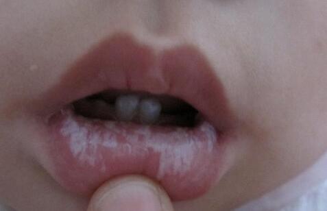 介绍下鹅口疮的常识
