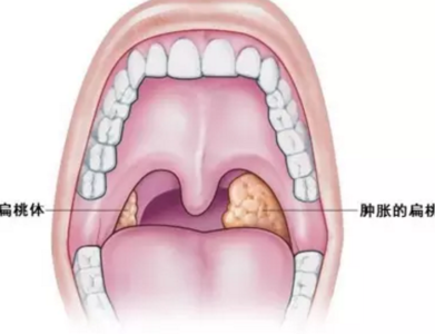 扁桃體結石概述,扁桃體結石疾病詳情,扁桃體結石病因,扁桃體結石症狀