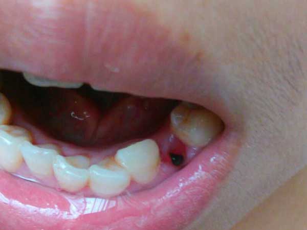 干槽症牙洞的样子图片