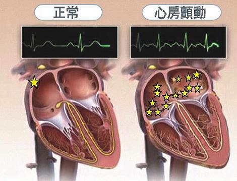 房颤属于重大疾病吗 发现房颤后买保险可以报销吗