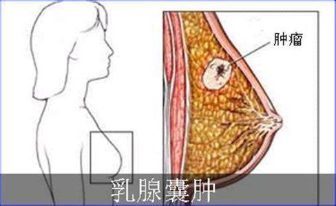乳腺囊肿有什么症状图片