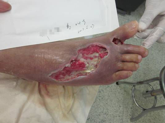 有效治疗糖尿病足的方法