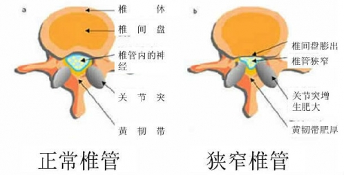 椎管狭窄常见的预防方法