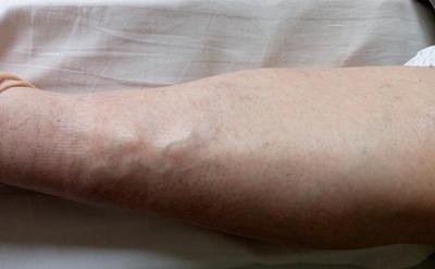 早期下肢静脉血栓图片图片