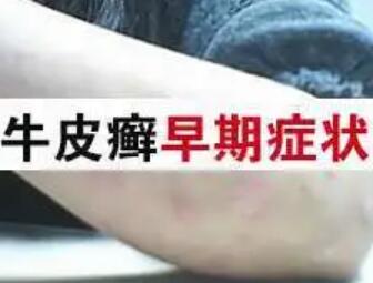 南昌治疗局限型牛皮癣医院哪家好