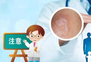 南昌哪家医院治疗牛皮癣比较好