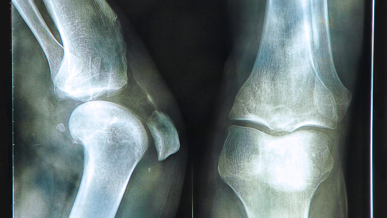 股骨头坏死有哪些常见的病因呢  股骨头坏死是什么原因造成的