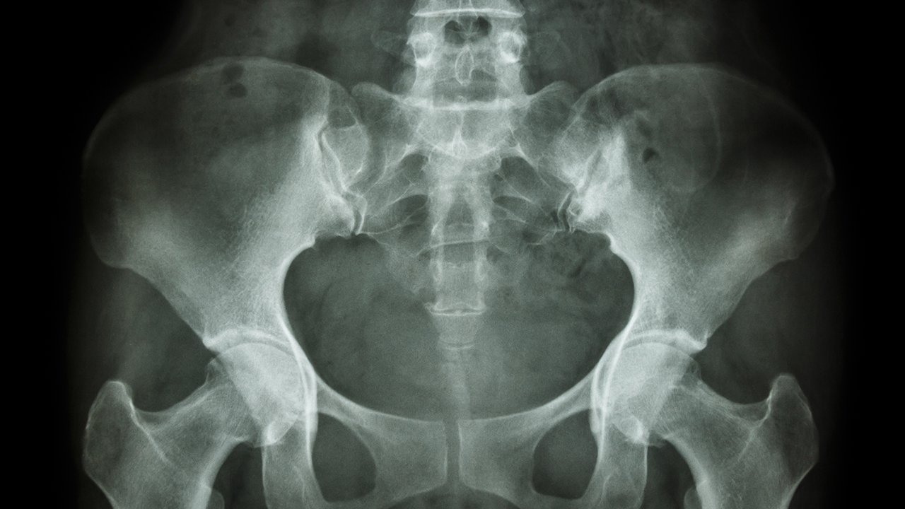 剖析股骨头坏死的治疗方案  股骨头坏死医院十大排名第一