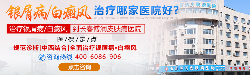 长春白癜风专科医院